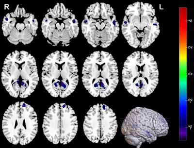 Changes in gray matter volume following electroconvulsive therapy in adolescent depression with suicidal ideation: A longitudinal structural magnetic resonance imaging study